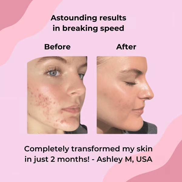 🍋LAST DAY 49% OFF🔥Turmeric Kojic Acid Cleansing Pads