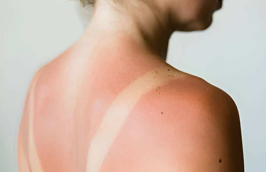 Does Glutathione Remove Tan? Combatting Sun Tan Does Glutathione Remove Tan? Combatting Sun Tan