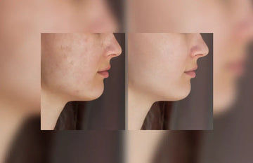 Glutathione-Tablet-Before-and-After-Glowing-Skin-Result