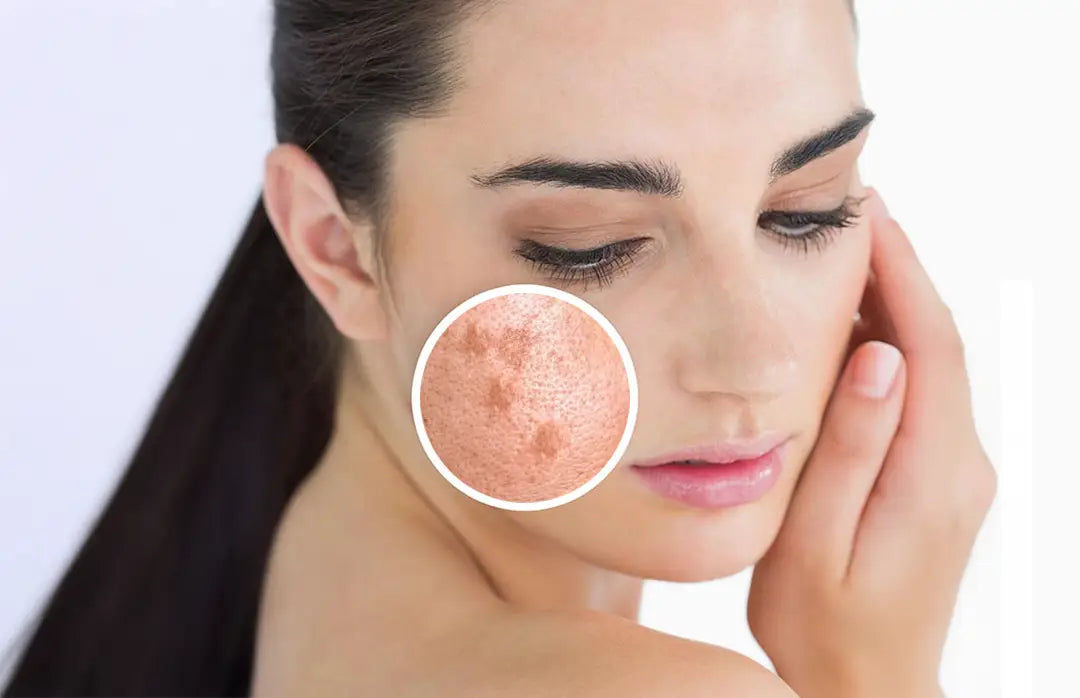 does glutathione cause pimples for Hyperpigmentation: How It Work? Scent:Unscented Size:500 Grams - Email for pricing Barrett's Esophagus - American