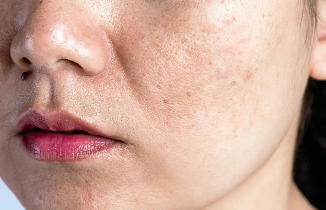 How Glutathione Helps to Reduce Skin Pigmentation How Glutathione Helps to Reduce Skin Pigmentation